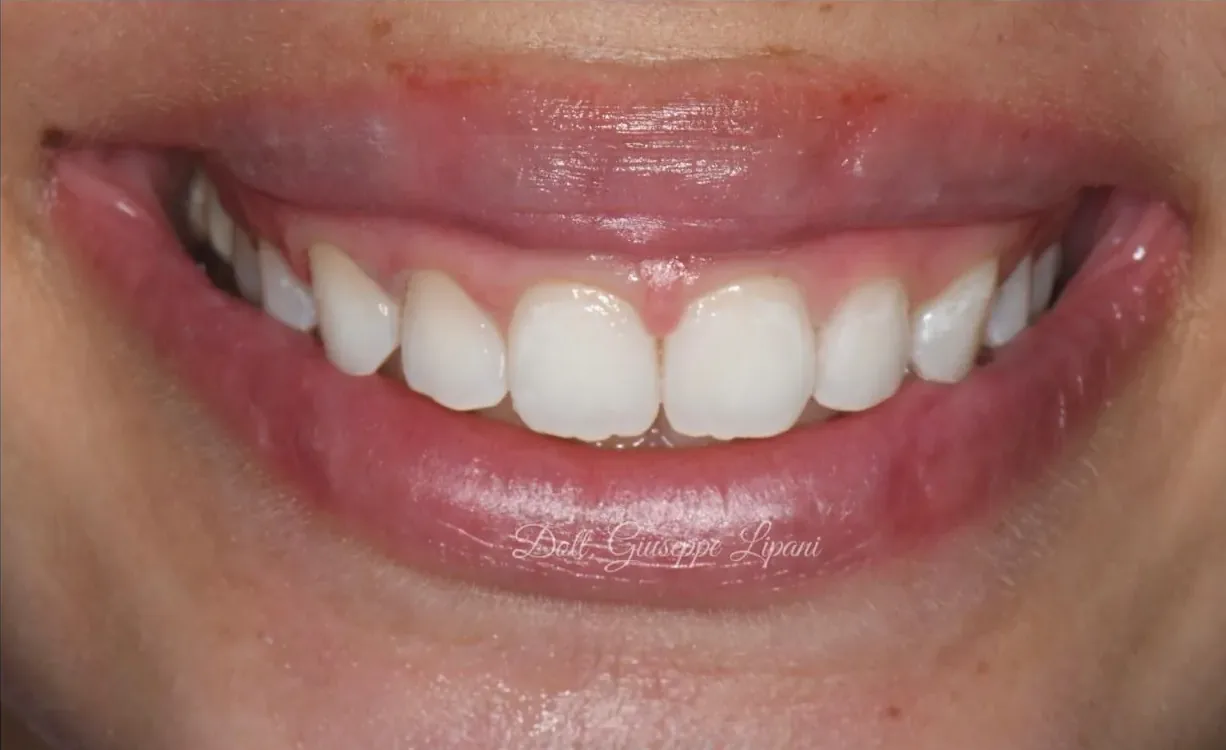 Lo stesso sorriso dopo il trattamento BlancOne®, con i denti visibilmente più bianchi
