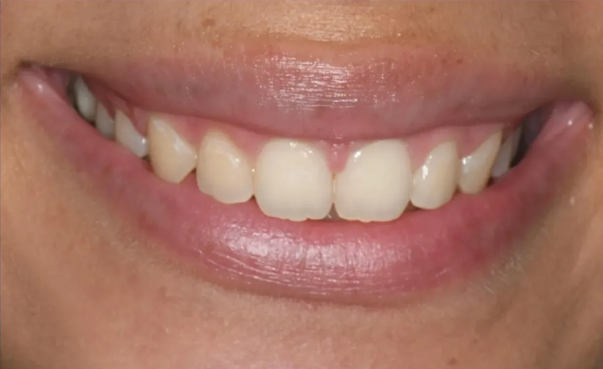 Sorriso prima del trattamento BlancOne®