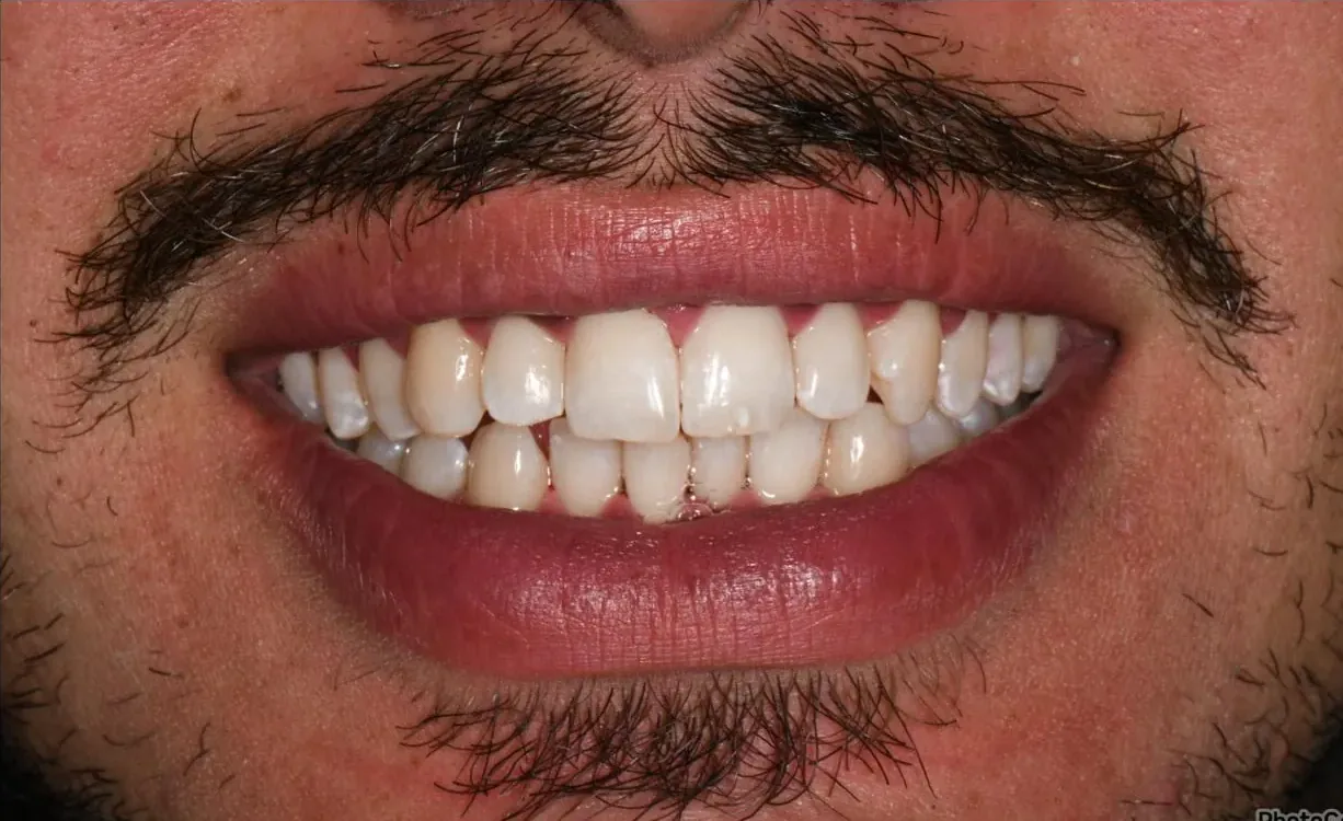 Lo stesso sorriso dopo il trattamento BlancOne®: denti più bianchi e uniformi