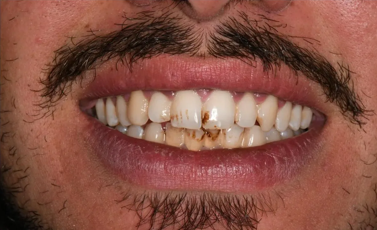 Sorriso con denti macchiati prima del trattamento BlancOne®